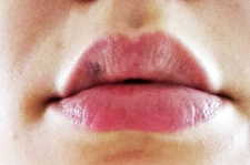 Dudak Morarması Belirtileri ve Tedavisi