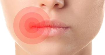 Dudak İltihabı Belirtileri ve Tedavisi